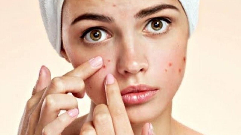 Se você tem acne e já fez tratamentos convencionais que não funcionaram, que tal tentar alternativas mais naturais? Existem muitas opções que não envolvem produtos industrializados (e caros) e que podem sim ser muito eficientes